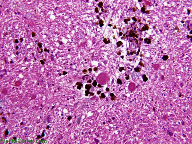 Superficial cirrhosis, H&E stained slide x 400